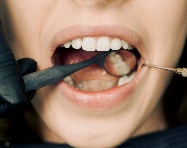 limpieza dental dentista