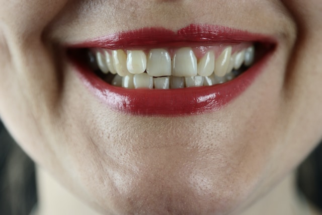 manchas blancas en los dientes ns